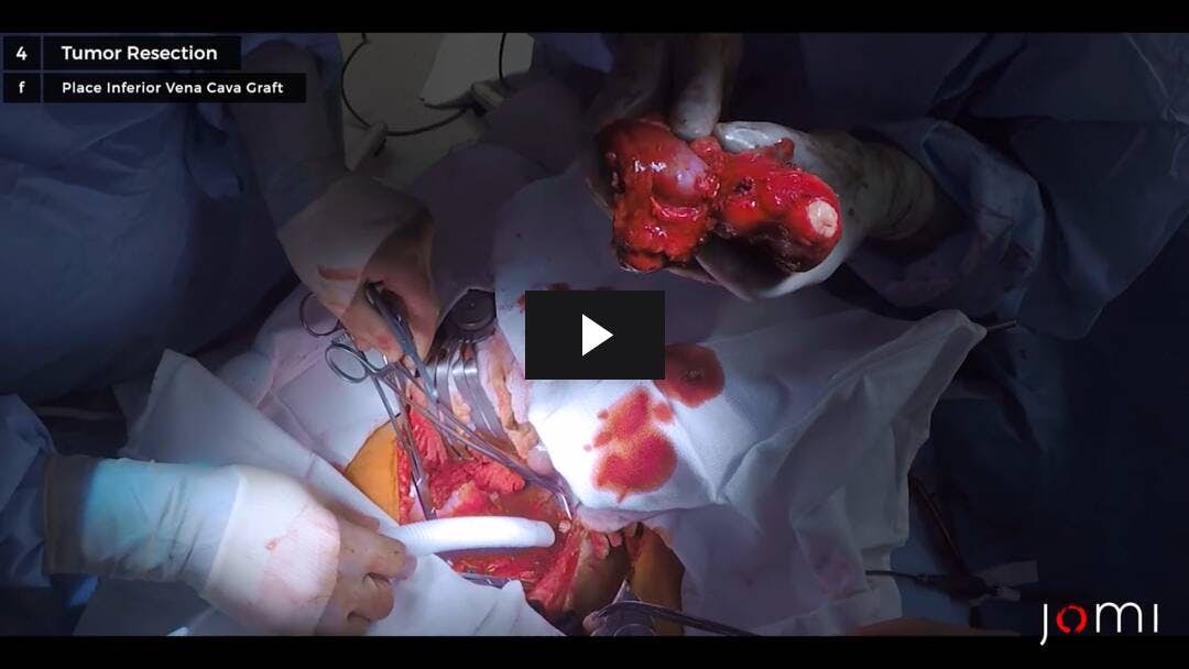 Video preload image for Leiomyosarcoma of Inferior Vena Cava: Resection and Reconstruction