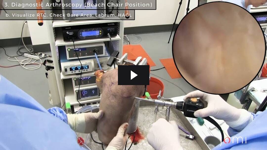 Video preload image for Diagnostische Schulterarthroskopie