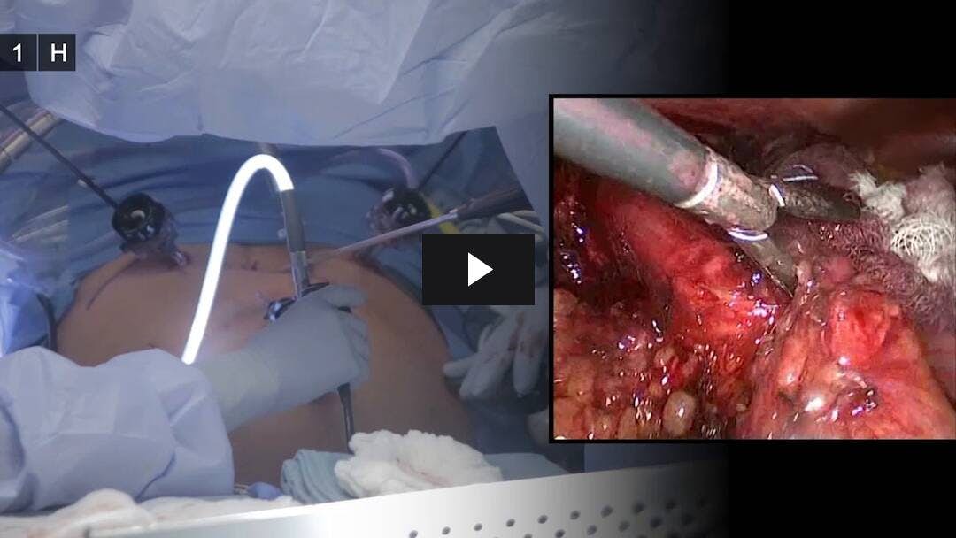 Video preload image for Laparoscopic Heller Myotomy