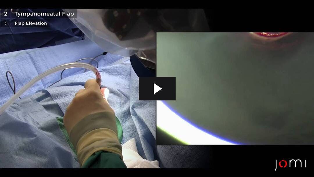 Video preload image for Laser Excision of Glomus Tympanicum (Transcanal Approach)