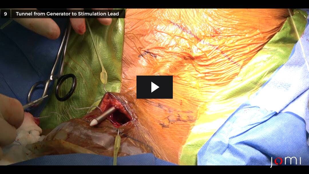 Video preload image for Hypoglossal Nerve Stimulator