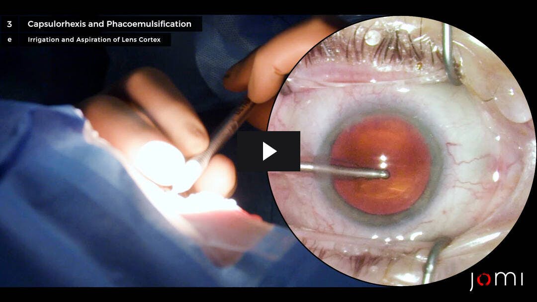 Video preload image for Cataract Extraction with Phacoemulsification and Posterior Chamber Intraocular Lens