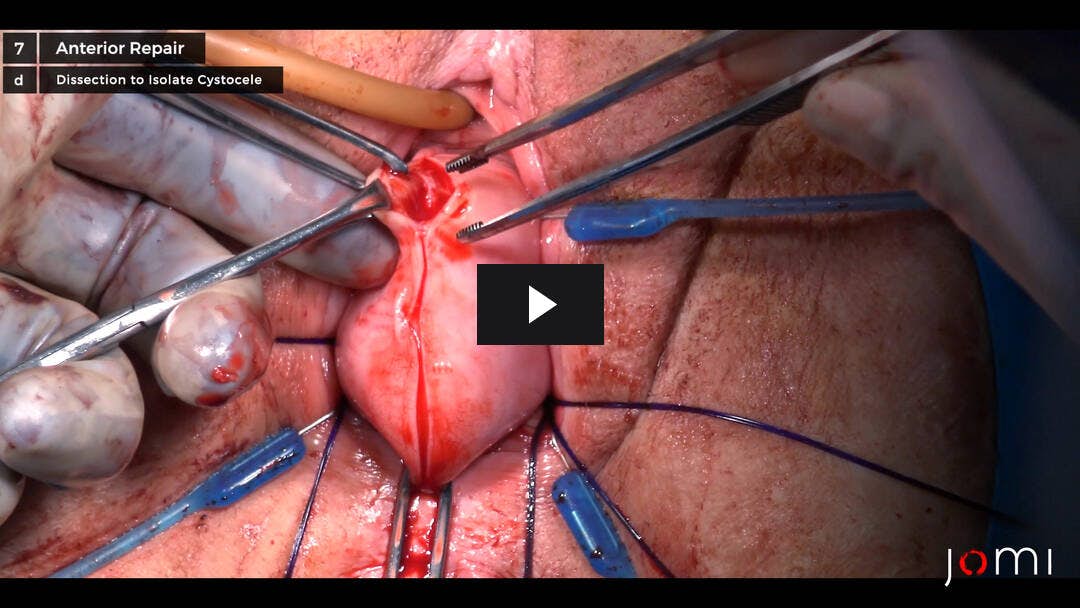 Video preload image for Histerectomía vaginal, suspensión del ligamento uterosacro, reparación anterior y perineorrafia