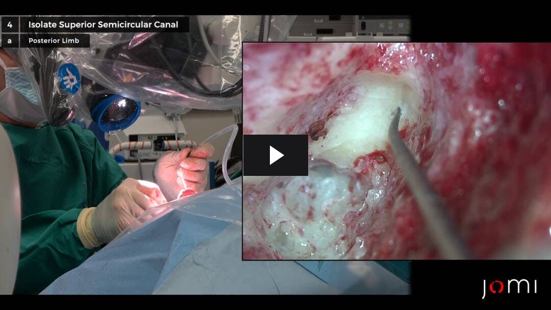Video preload image for Transmastoid Repair of Superior Semicircular Canal Dehiscence