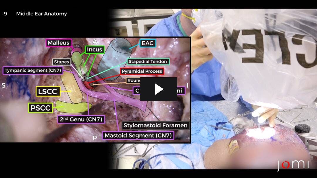 Video preload image for Temporal Bone Dissection (Cadaver)