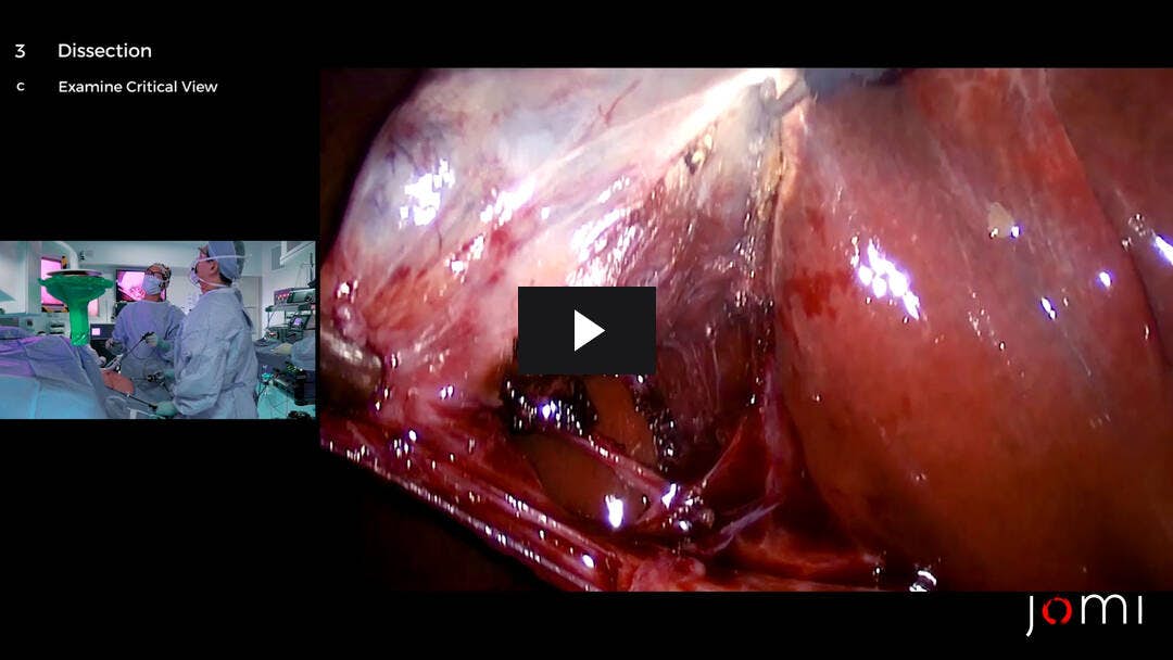 Video preload image for Laparoscopic Cholecystectomy