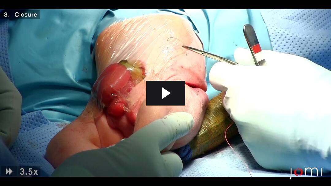 Video preload image for Pelvic Osteotomies for Cloacal Exstrophy
