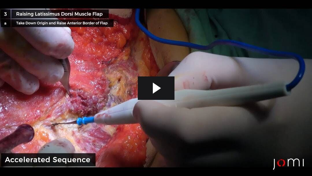 Video preload image for The Versatile Latissimus Dorsi Muscle as a Local Flap for Chest Wall Coverage