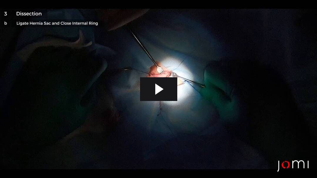 Video preload image for Reparación de hernia inguinal abierta abierta bilateral pediátrica del lactante - Twin B