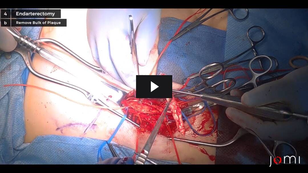 Video preload image for Femoral Endarterectomy for Severe Peripheral Arterial Disease