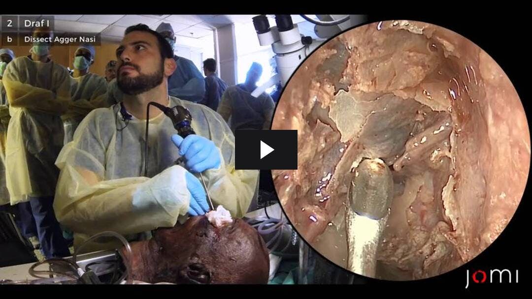 Video preload image for Frontal Sinus Dissection (Cadaver)