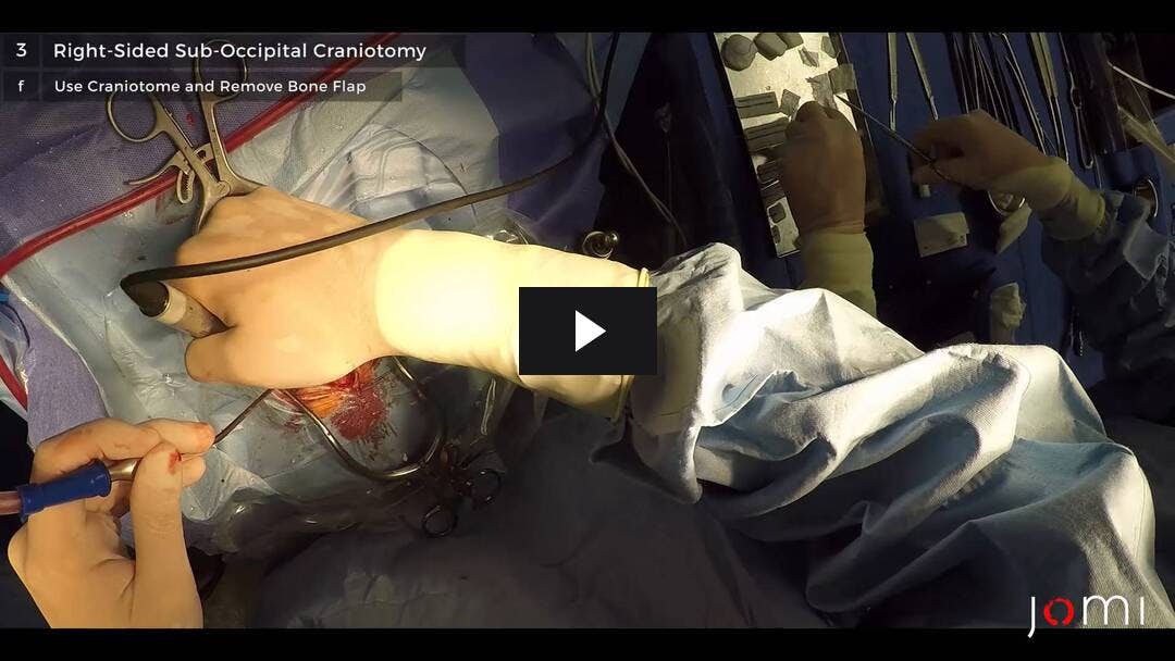 Video preload image for Drenaje extraventricular y evacuación del hematoma para tratar la hidrocefalia después de la lisis de la embolia de MCA