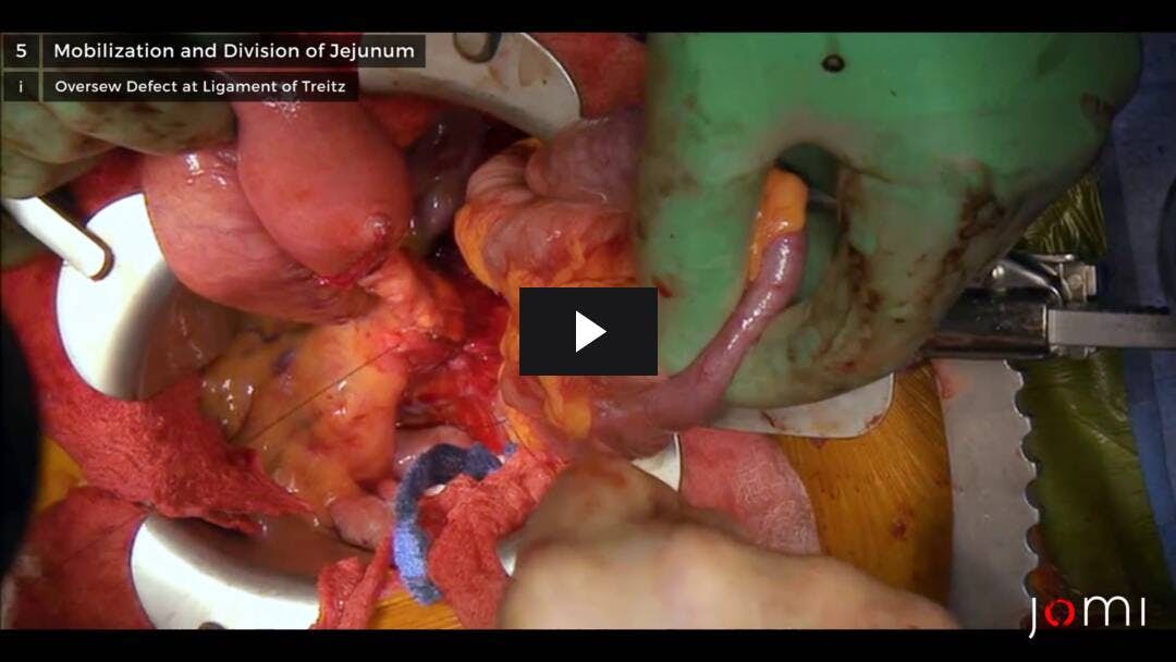Video preload image for Whipple-Verfahren bei multipler endokriner Neoplasie der Bauchspeicheldrüse