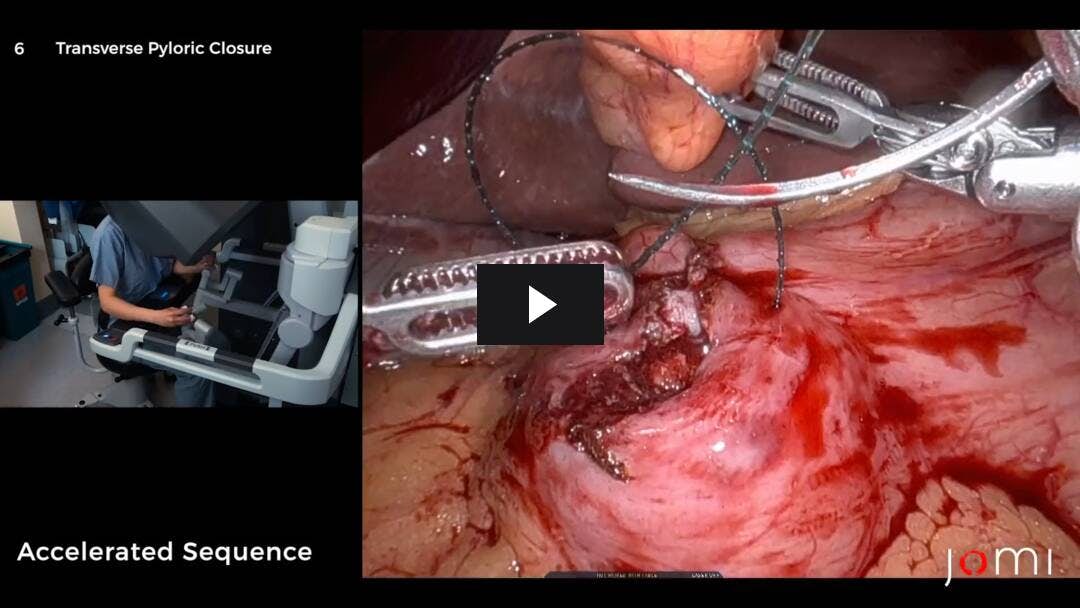 Video preload image for Robotic Heineke-Mikulicz Pyloroplasty for Pyloric Stenosis