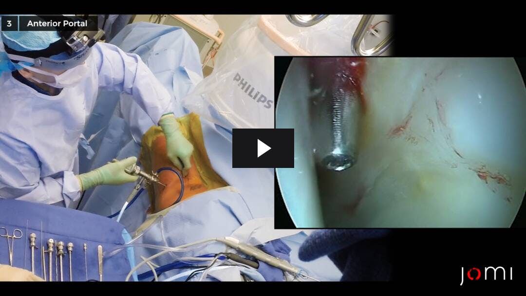 Video preload image for Colocación del portal para la artroscopia de cadera