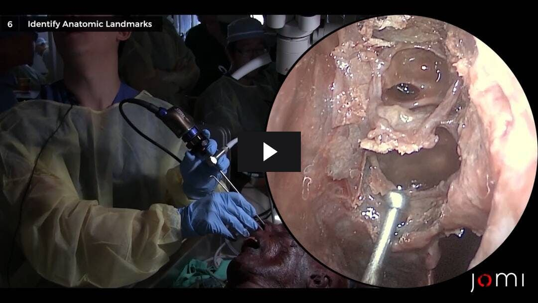 Video preload image for Functional Endoscopic Sinus Surgery: Maxillary, Ethmoid, and Sphenoid (Cadaver)