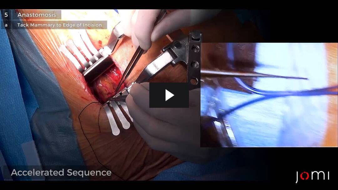 Video preload image for Bypass directo de la arteria coronaria mínimamente invasivo