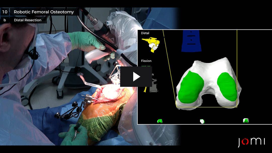 Video preload image for Artroplastia total de rodilla asistida por brazo robótico Mako