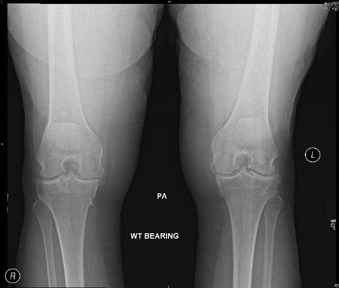 Pre-op x-rays.