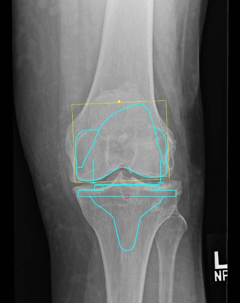 Pre-op x-rays.