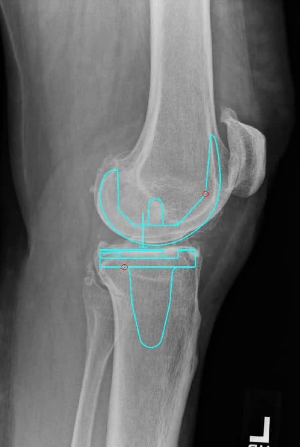 Pre-op x-rays.