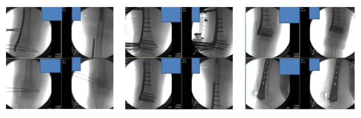 0099Intraop