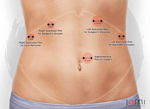 Port placement sites for laparoscopic paraesophageal hernia repair.