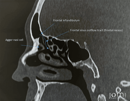 Frontal Sinus Outflow Tract on CT.