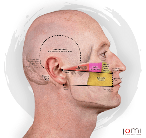 Soft Tissue Landmarks for Lateral Skull Base Surgery.