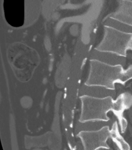 CTA showing that the atheroma extended proximally to the level of the superior mesenteric artery (SMA), which would have comp