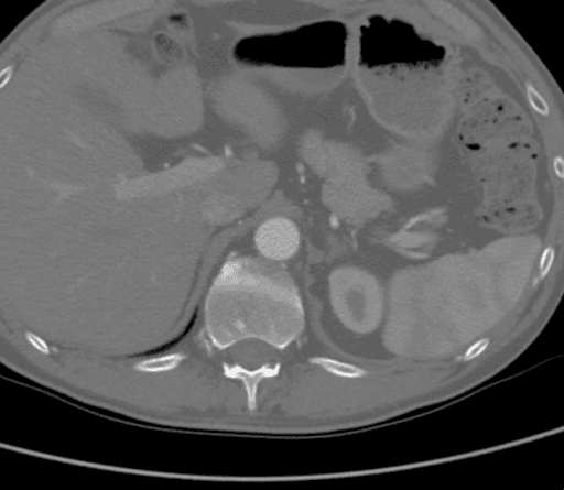 CTA showing that the supraceliac aorta was free of arterial disease.