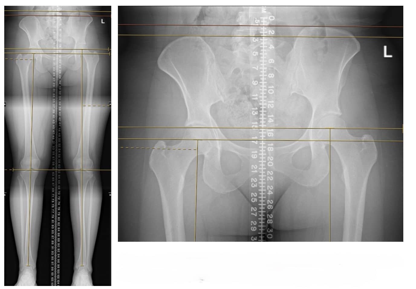 Presentation images with a 17-mm leg-length discrepancy (right shorter than left), from femur.Most recent follow up, 9 months