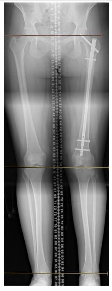 Presentation images with a 17-mm leg-length discrepancy (right shorter than left), from femur.Most recent follow up, 9 months