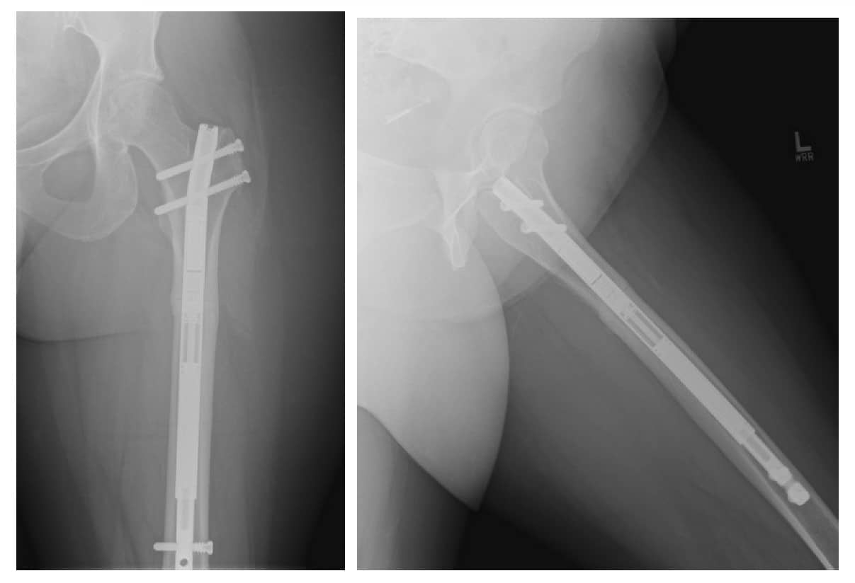 Presentation images with a 17-mm leg-length discrepancy (right shorter than left), from femur.Most recent follow up, 9 months