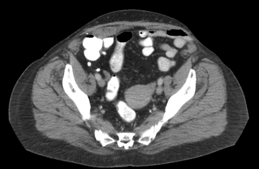 Axial view of a CT abdomen pelvis of this patient demonstrating a left lower quadrant partial-thickness incisional hernia. Th