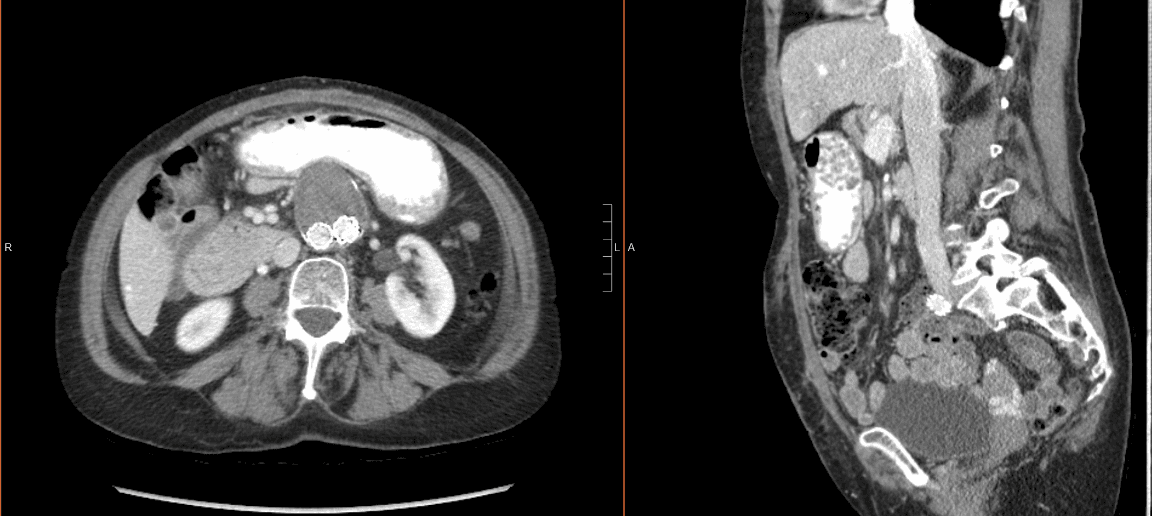 The axial plane (left) and sagittal plane (right) of the CT scan show prior right colectomy and previous endovascular repair 