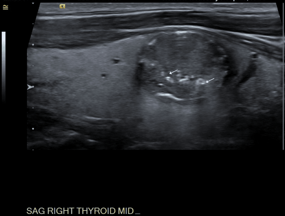 Sagittal view of nodule.