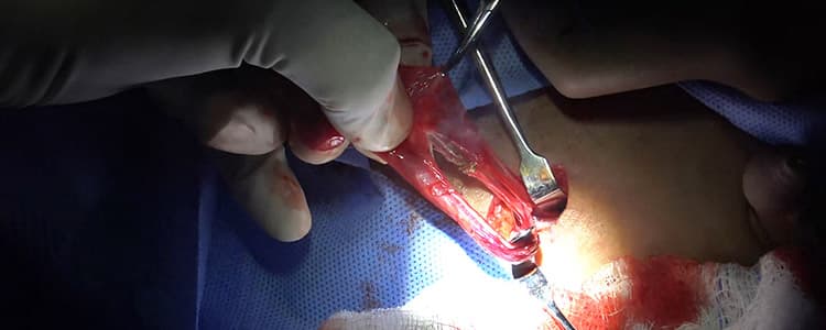 Right Orchiopexy to Correct Undescended Testicle and Circumcision to Correct Phimosis