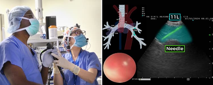 endobronchial-ultrasound-bronchoscopy-guided-biopsy-for-lymphoma