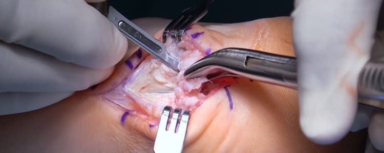 Posterior Calcaneal Osteophyte Excision with Subsequent Achilles Tendon Repair