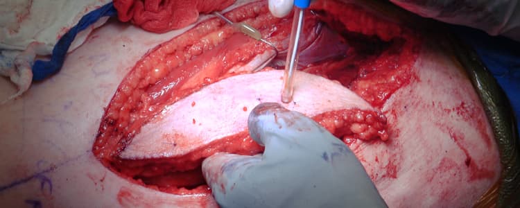 anterolateral-thigh-free-flap-reconstruction-of-parotidectomy-defect