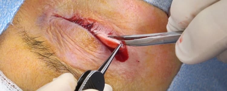 lateral-tarsal-strip-procedure-for-right-lower-eyelid-ectropion