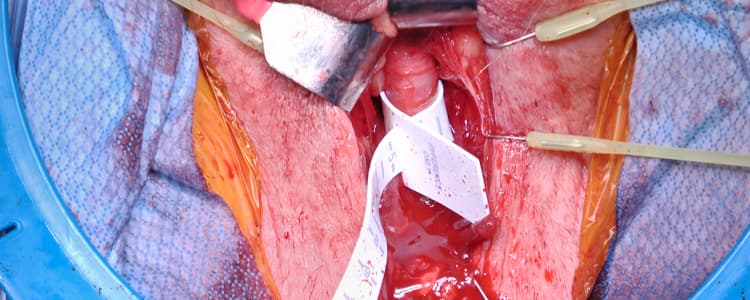 artificial-urinary-sphincter-placement-for-male-with-urinary-incontinence-following-radical-prostatectomy