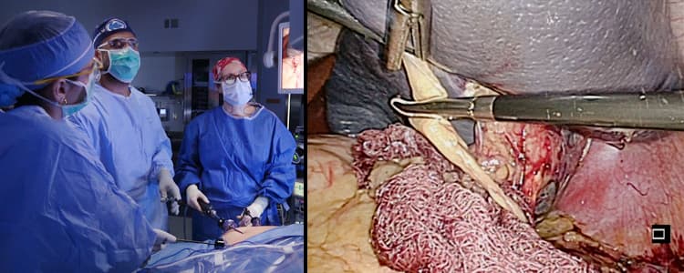 pediatric-laparoscopic-splenectomy-for-splenomegaly-due-to-hereditary-spherocytosis