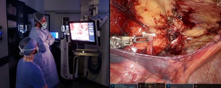 Robotic-Assisted Transabdominal Preperitoneal (rTAPP) Femoral Hernia Repair
