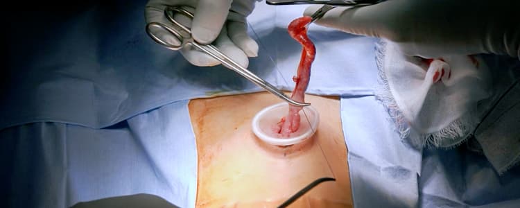 single-port-hybrid-open-and-laparoscopic-approach-for-pediatric-appendectomy-for-acute-appendicitis