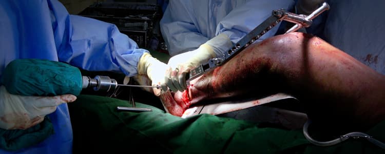 Single-Incision Retrograde SIGN Nailing of the Femur and Antegrade SIGN Nailing of the Tibia for a Delayed-Presentation Floating Knee Injury