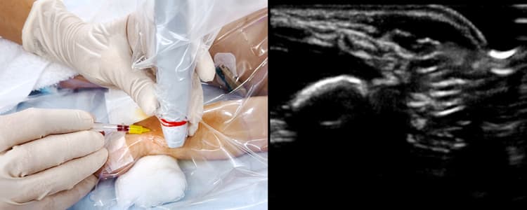 Ultrasound-Guided Radial Artery Catheterization in a Four-Month-Old Boy