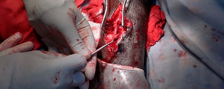 Debridement, Irrigation, and Decompression of the Bone for Chronic Osteomyelitis of the Distal Tibia and Active Sinuses
