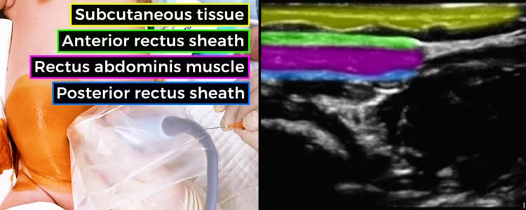 Ultrasound-Guided Rectus Sheath Block in a Pediatric Patient